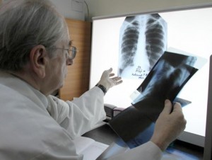 химиотерапия туберкулеза