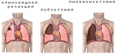 лобэктомия туберкулез 